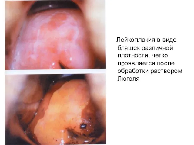 Лейкоплакия в виде бляшек различной плотности, четко проявляется после обработки раствором Люголя