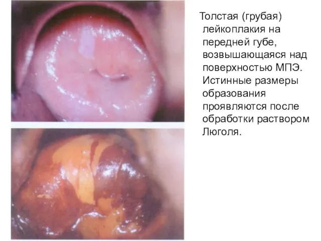 Толстая (грубая) лейкоплакия на передней губе, возвышающаяся над поверхностью МПЭ. Истинные размеры