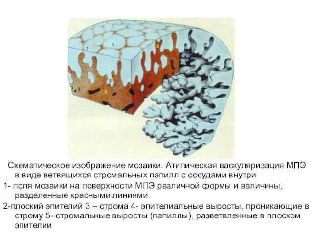 Схематическое изображение мозаики. Атипическая васкуляризация МПЭ в виде ветвящихся стромальных папилл с