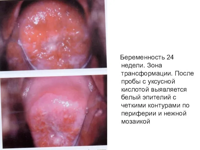 Беременность 24 недели. Зона трансформации. После пробы с уксусной кислотой выявляется белый