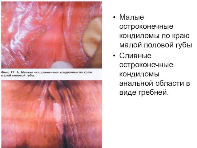 Малые остроконечные кондиломы по краю малой половой губы Сливные остроконечные кондиломы анальной области в виде гребней.