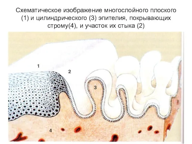 Схематическое изображение многослойного плоского (1) и цилиндрического (3) эпителия, покрывающих строму(4), и участок их стыка (2)