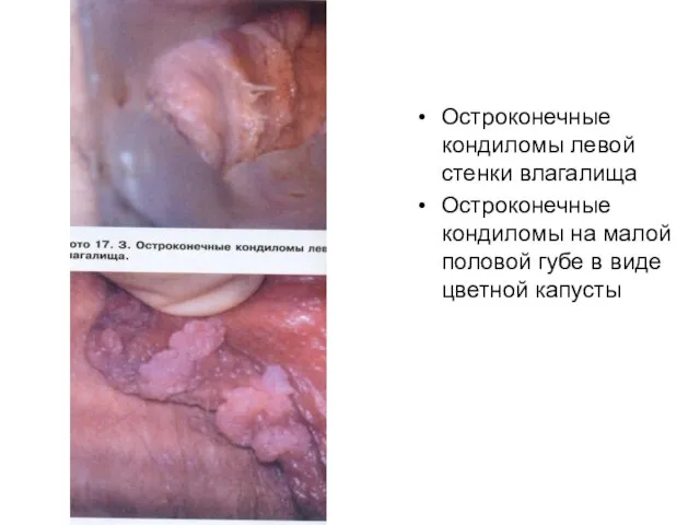 Остроконечные кондиломы левой стенки влагалища Остроконечные кондиломы на малой половой губе в виде цветной капусты
