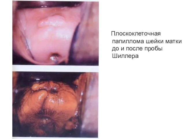 Плоскоклеточная папиллома шейки матки до и после пробы Шиллера