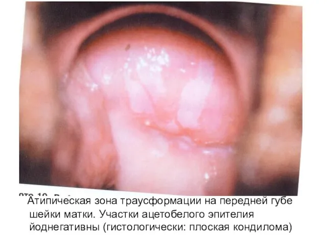 Атипическая зона траусформации на передней губе шейки матки. Участки ацетобелого эпителия йоднегативны (гистологически: плоская кондилома)