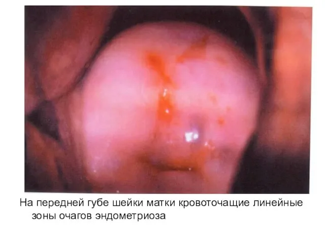 На передней губе шейки матки кровоточащие линейные зоны очагов эндометриоза