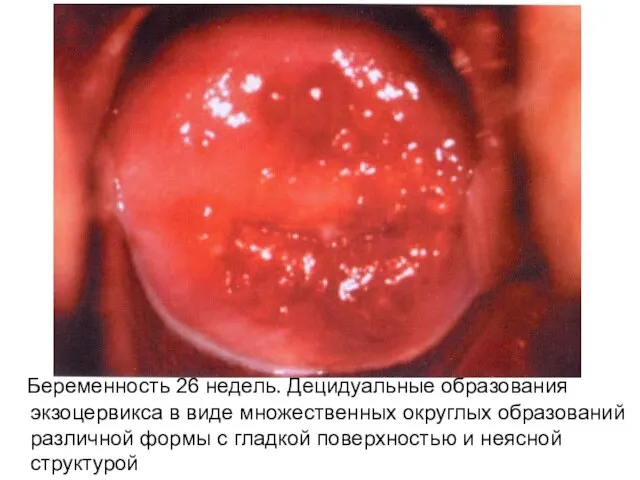 Беременность 26 недель. Децидуальные образования экзоцервикса в виде множественных округлых образований различной