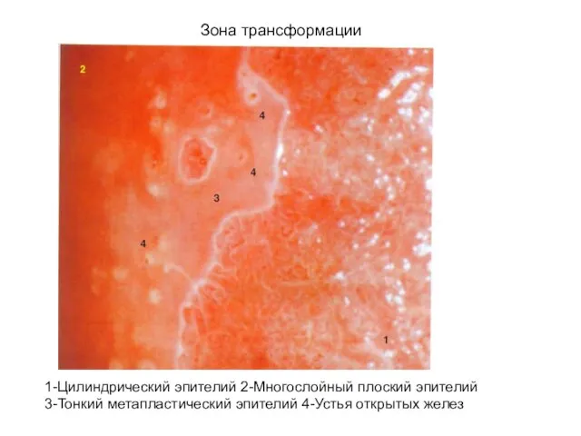 Зона трансформации 1-Цилиндрический эпителий 2-Многослойный плоский эпителий 3-Тонкий метапластический эпителий 4-Устья открытых желез