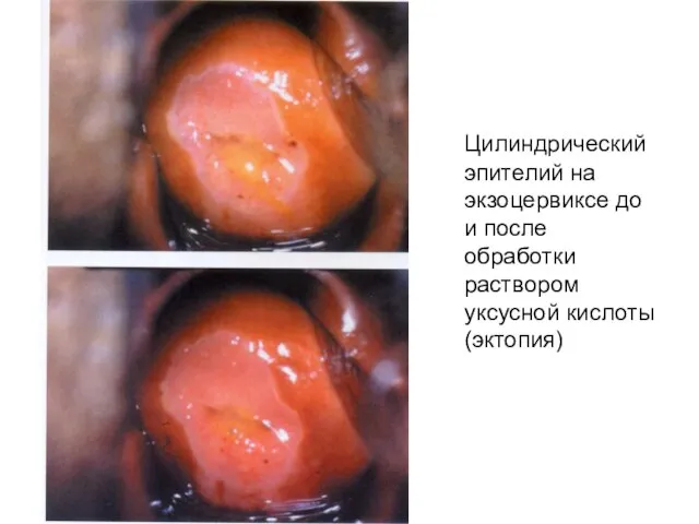 Цилиндрический эпителий на экзоцервиксе до и после обработки раствором уксусной кислоты (эктопия)
