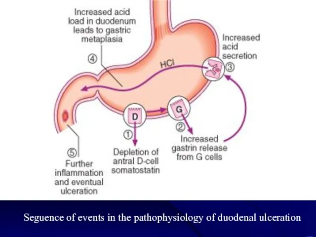 Seguence of events in the pathophysiology of duodenal ulceration