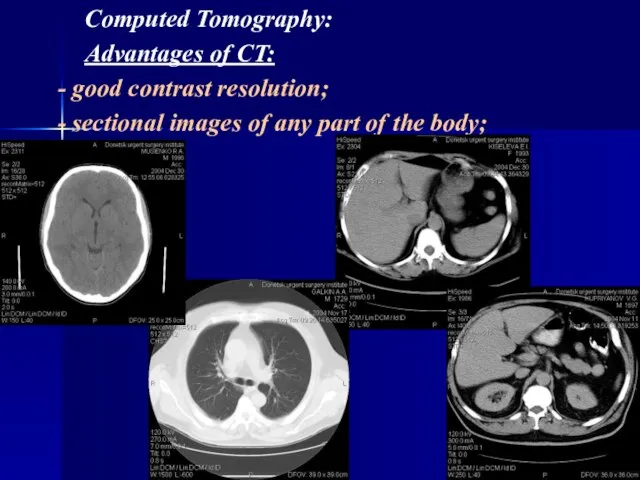 Computed Tomography: Advantages of CT: - good contrast resolution; - sectional images