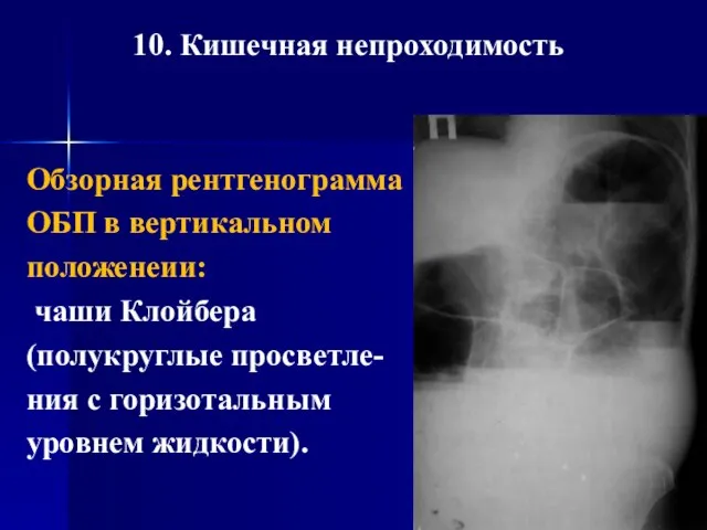 10. Кишечная непроходимость Обзорная рентгенограмма ОБП в вертикальном положенеии: чаши Клойбера (полукруглые