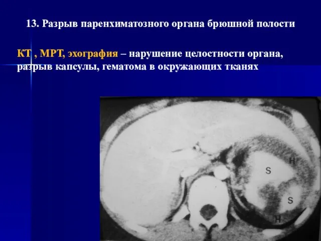 13. Разрыв паренхиматозного органа брюшной полости КТ , МРТ, эхография – нарушение