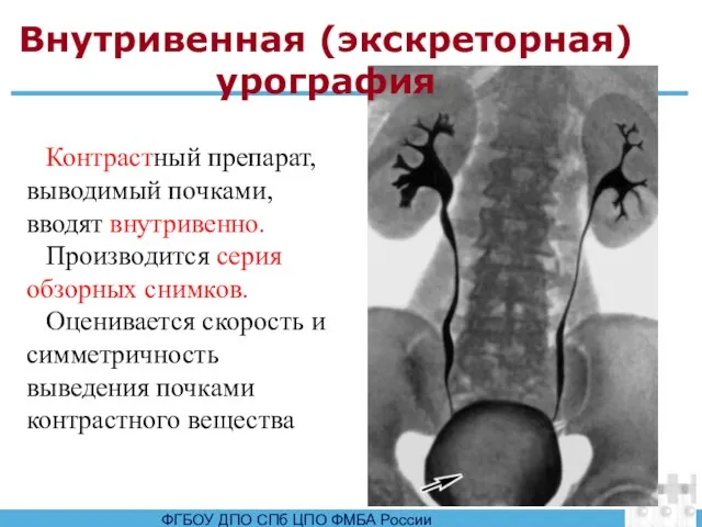 Внутривенная (экскреторная) урография Контрастный препарат, выводимый почками, вводят внутривенно. Производится серия обзорных