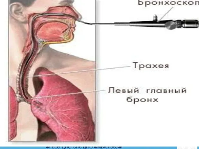 Бронхоскопия - эндоскопический метод оценки слизистой оболочки и просвета трахеи и бронхов