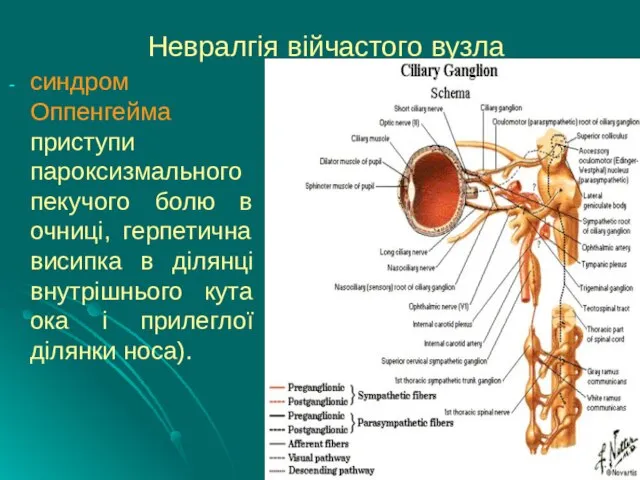 Невралгія війчастого вузла синдром Оппенгейма приступи пароксизмального пекучого болю в очниці, герпетична