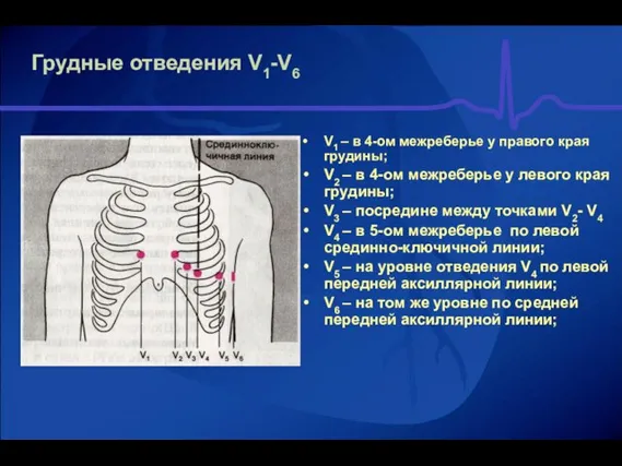 Грудные отведения V1-V6 V1 – в 4-ом межреберье у правого края грудины;