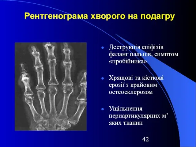 Рентгенограма хворого на подагру Деструкція епіфізів фаланг пальців, симптом «пробійника» Хрящові та