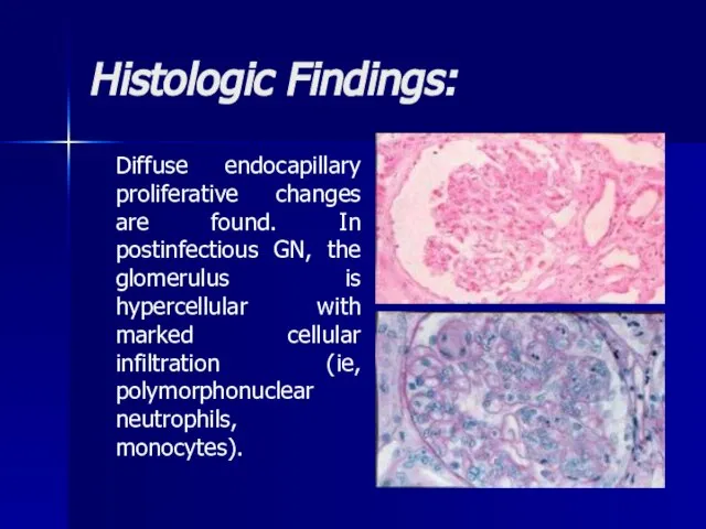 Histologic Findings: Diffuse endocapillary proliferative changes are found. In postinfectious GN, the