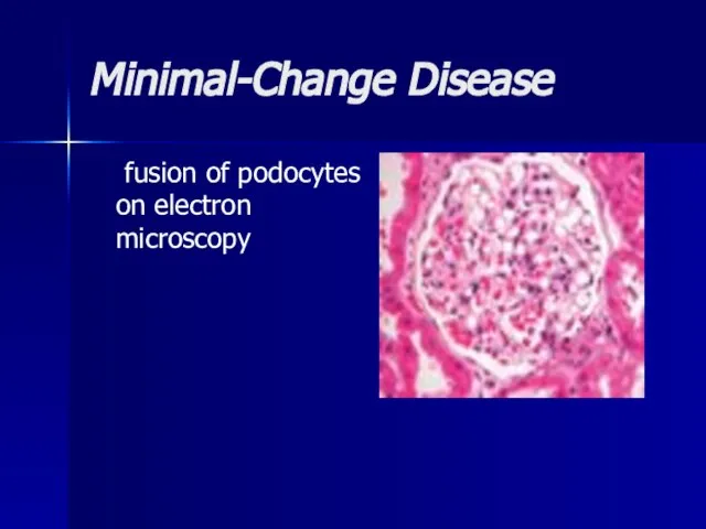 Minimal-Change Disease fusion of podocytes on electron microscopy