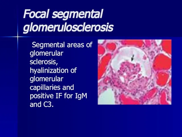Focal segmental glomerulosclerosis Segmental areas of glomerular sclerosis, hyalinization of glomerular capillaries