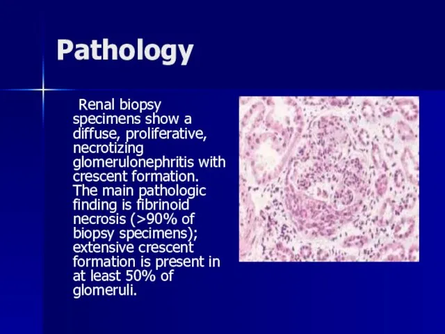 Pathology Renal biopsy specimens show a diffuse, proliferative, necrotizing glomerulonephritis with crescent