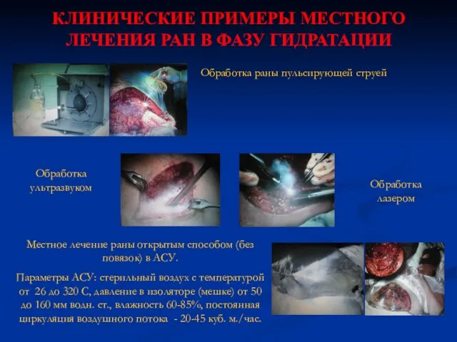 КЛИНИЧЕСКИЕ ПРИМЕРЫ МЕСТНОГО ЛЕЧЕНИЯ РАН В ФАЗУ ГИДРАТАЦИИ Обработка раны пульсирующей струей