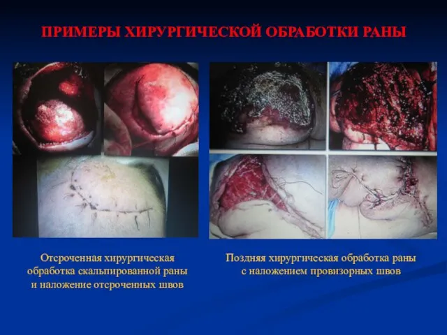 ПРИМЕРЫ ХИРУРГИЧЕСКОЙ ОБРАБОТКИ РАНЫ Отсроченная хирургическая обработка скальпированной раны и наложение отсроченных