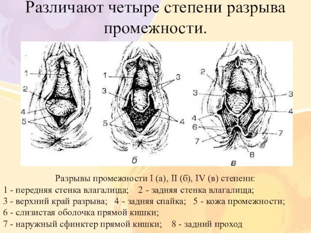 Различают четыре степени разрыва промежности. Разрывы промежности I (а), II (б), IV