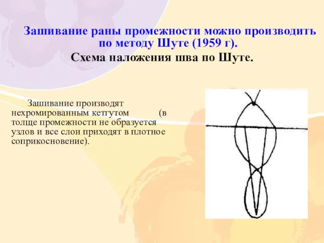 Зашивание раны промежности можно производить по методу Шуте (1959 г). Схема наложения