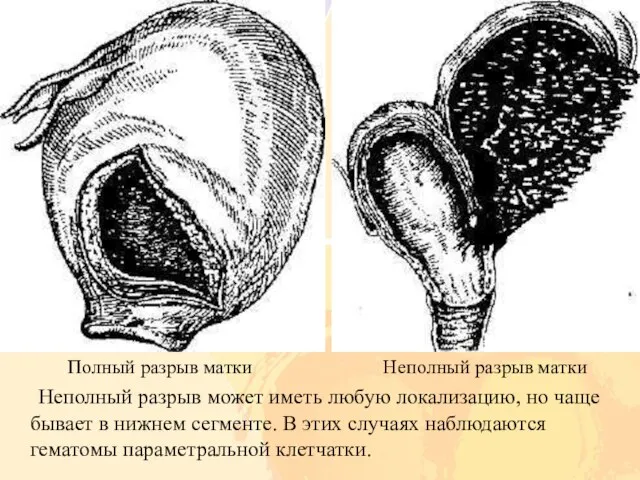 Полный разрыв матки Неполный разрыв матки Неполный разрыв может иметь любую локализацию,