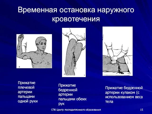 СПб Центр последипломного образования Временная остановка наружного кровотечения Прижатие плечевой артерии пальцами