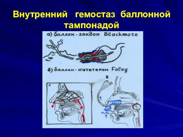 Внутренний гемостаз баллонной тампонадой