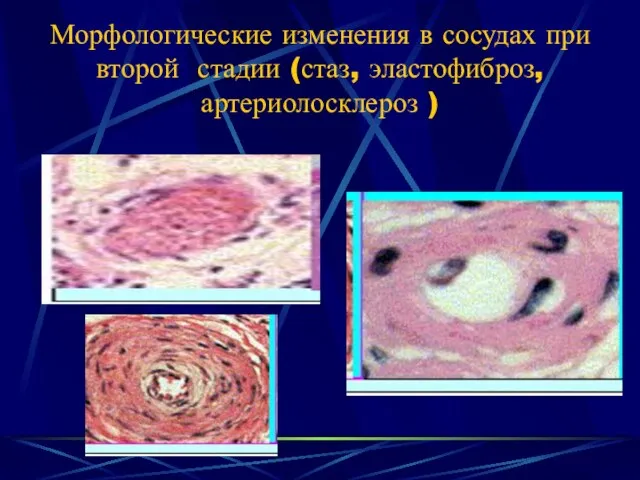 Морфологические изменения в сосудах при второй стадии (стаз, эластофиброз, артериолосклероз )