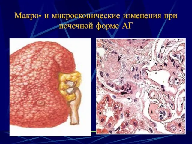 Макро- и микроскопические изменения при почечной форме АГ