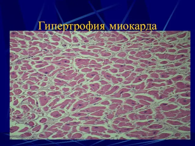 Гипертрофия миокарда