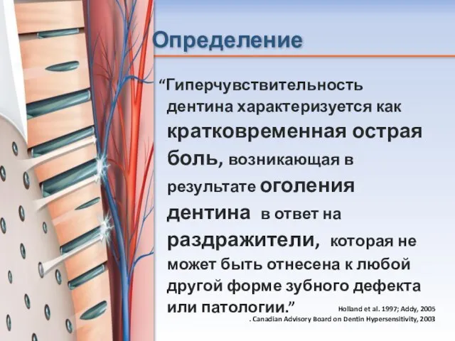 Определение “Гиперчувствительность дентина характеризуется как кратковременная острая боль, возникающая в результате оголения