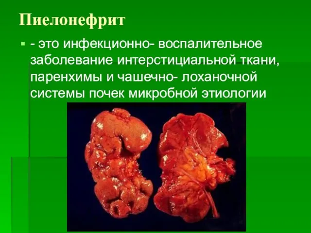 Пиелонефрит - это инфекционно- воспалительное заболевание интерстициальной ткани, паренхимы и чашечно- лоханочной системы почек микробной этиологии