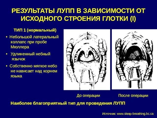 РЕЗУЛЬТАТЫ ЛУПП В ЗАВИСИМОСТИ ОТ ИСХОДНОГО СТРОЕНИЯ ГЛОТКИ (I) ТИП 1 (нормальный)