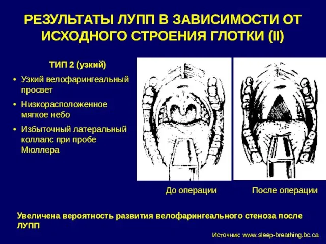 РЕЗУЛЬТАТЫ ЛУПП В ЗАВИСИМОСТИ ОТ ИСХОДНОГО СТРОЕНИЯ ГЛОТКИ (II) ТИП 2 (узкий)