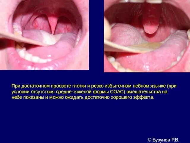 При достаточном просвете глотки и резко избыточном небном язычке (при условии отсутствия