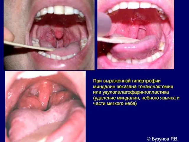 © Бузунов Р.В. При выраженной гипертрофии миндалин показана тонзиллэктомия или увулопалатофарингопластика (удаление