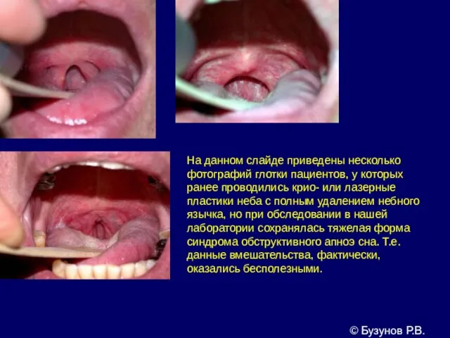 На данном слайде приведены несколько фотографий глотки пациентов, у которых ранее проводились