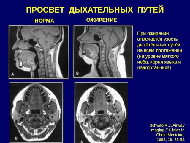 НОРМА ОЖИРЕНИЕ ПРОСВЕТ ДЫХАТЕЛЬНЫХ ПУТЕЙ Schwab R.J. Airway imaging // Clinics in