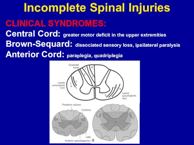 Incomplete Spinal Injuries CLINICAL SYNDROMES: Central Cord: greater motor deficit in the