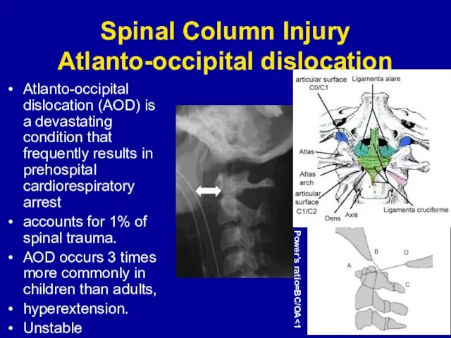 Spinal Column Injury Atlanto-occipital dislocation Atlanto-occipital dislocation (AOD) is a devastating condition