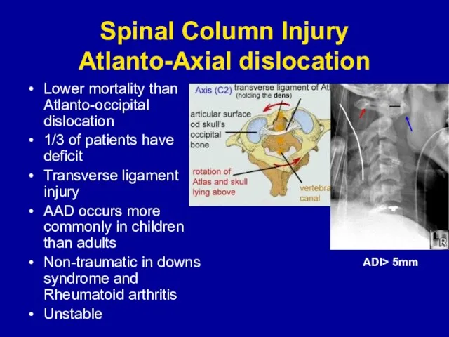 Spinal Column Injury Atlanto-Axial dislocation Lower mortality than Atlanto-occipital dislocation 1/3 of