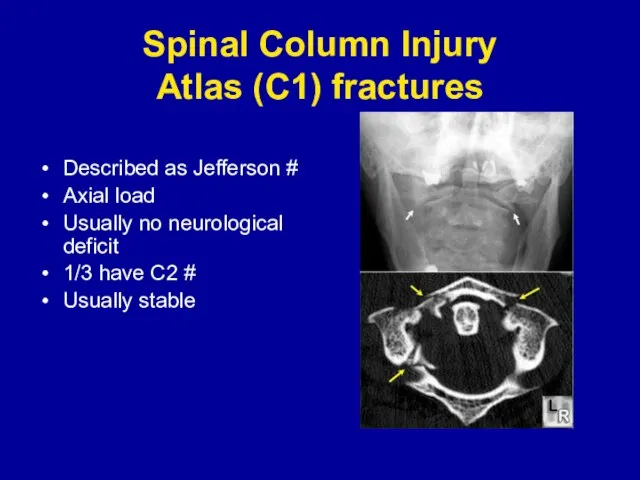 Spinal Column Injury Atlas (C1) fractures Described as Jefferson # Axial load