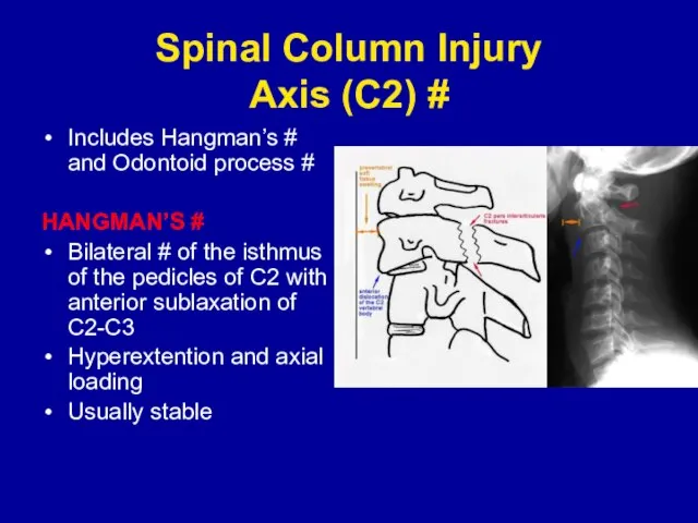 Spinal Column Injury Axis (C2) # Includes Hangman’s # and Odontoid process