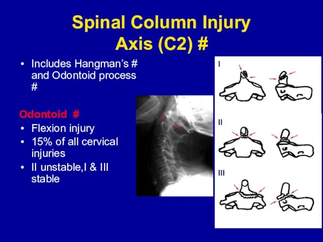 Spinal Column Injury Axis (C2) # Includes Hangman’s # and Odontoid process